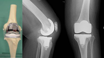 通常の人工膝関節（TKA）