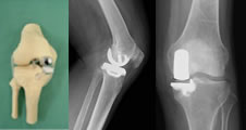 傷んだ内側だけを部分的に置換する人工膝関節（UKA）
